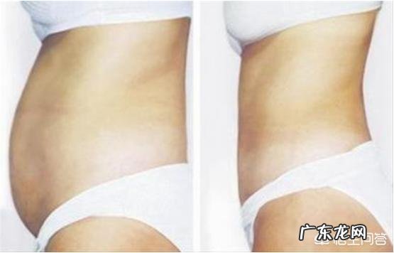 抽脂减肥有危害吗会不会反弹