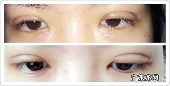 做完双眼皮手术,如何快速恢复?