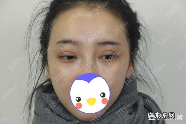 做完双眼皮手术,如何快速恢复?