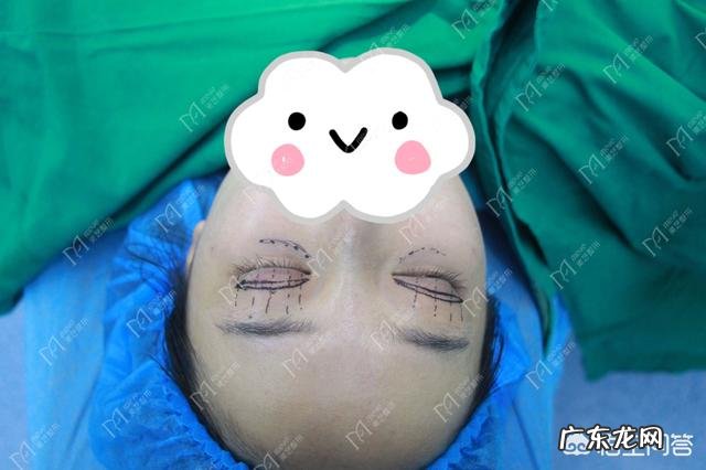 做完双眼皮手术,如何快速恢复?