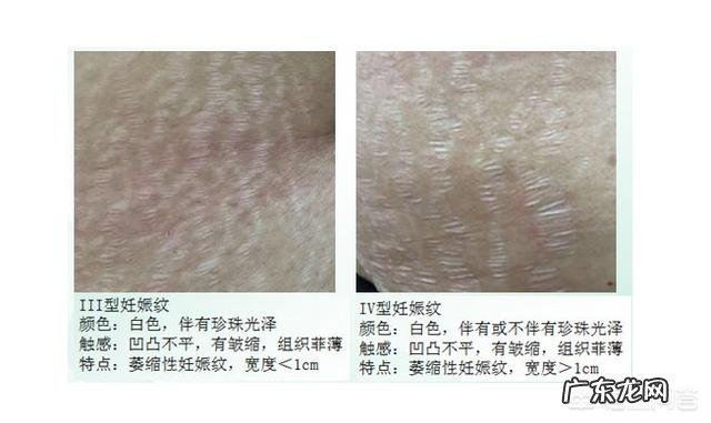 孕妈妈的妊娠纹是怎么产生的,可以预防和祛除吗?