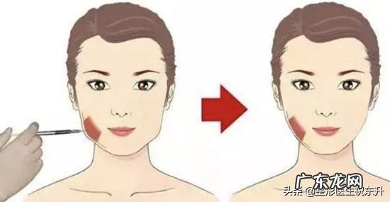 什么样的人适合打瘦脸针打完能有多大变化