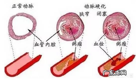高血脂患者适合做什么运动,怎么才能帮助自己更快得降脂呢