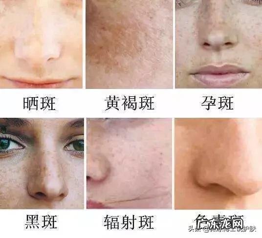 你真的了解斑吗为什么斑会反弹有什么办法能解决斑点肌肤