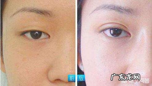 做完双眼皮手术之后，有哪些注意事项？