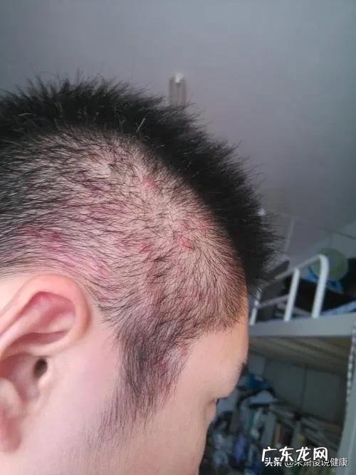 头皮里经常长疙瘩，可能有哪些原因？有没有哪些快速消除的办法？