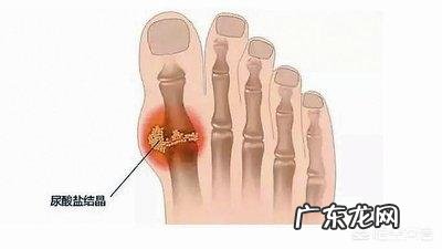 痛风患者吃着药为什么还会疼