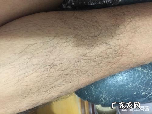 服用激素药物后,该如何减肥