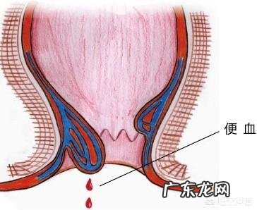 大便出现哪些异常有患肠癌的风险