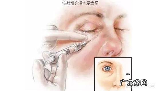 泪沟填充后多久可以碰,每天在眼部按摩可以吗