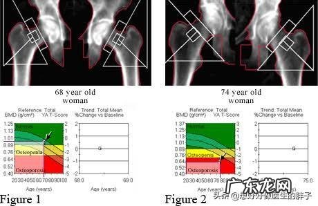 人到中年,骨质疏松,用什么方法补钙效果最好?