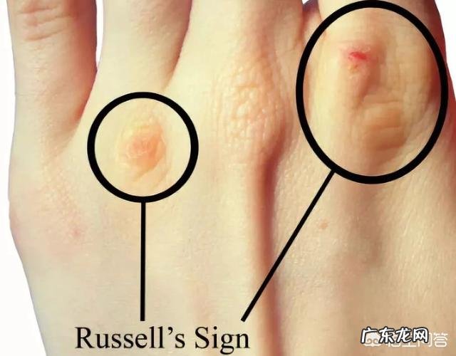 催吐式减肥能不能让自己瘦下来