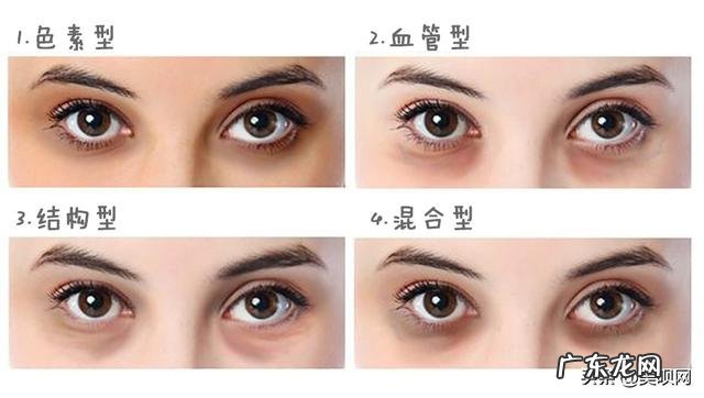 天生泪沟及血管型黑眼圈有改善的办法吗