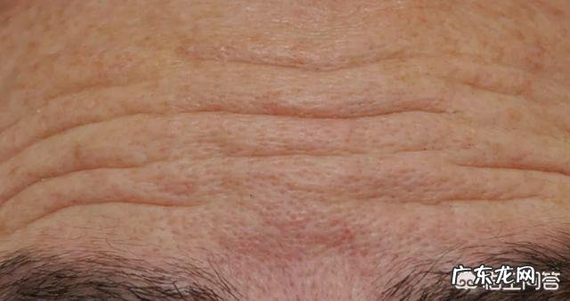 抬头纹很严重，有什么比较好的办法吗？