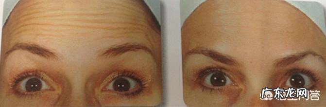 抬头纹很严重，有什么比较好的办法吗？