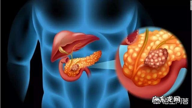 哪些原因会导致胰腺癌？胰腺癌是“吃”出来的吗？