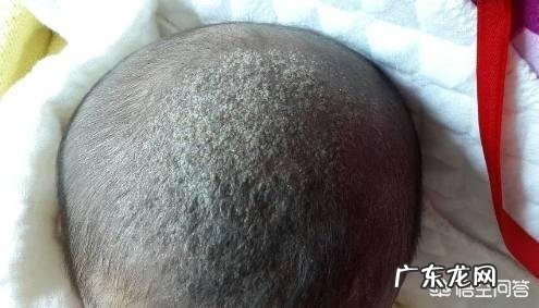 什么原因会导致新生儿的头上有污垢？