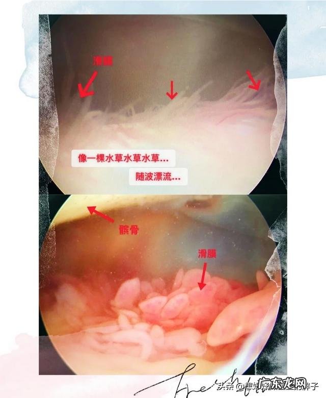 五岁宝宝滑膜炎不疼后怎么护理？