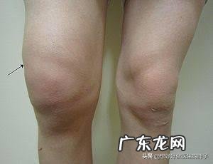 五岁宝宝滑膜炎不疼后怎么护理?