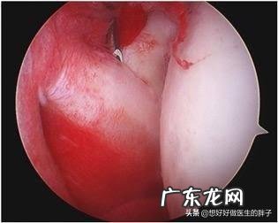 五岁宝宝滑膜炎不疼后怎么护理？