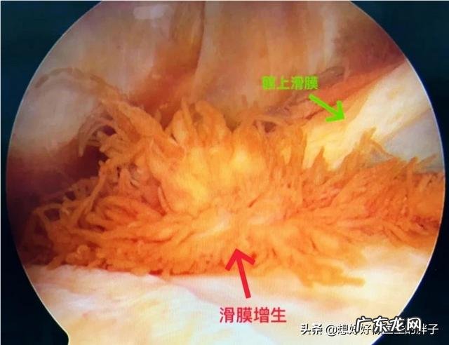五岁宝宝滑膜炎不疼后怎么护理?