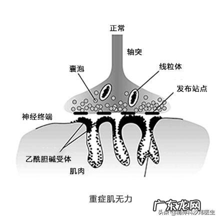 重症肌无力患者如何改善生活质量？