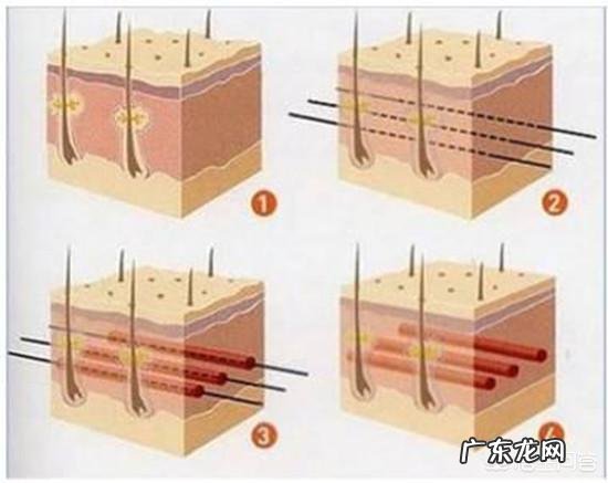 请问现在埋线大概多少钱,能保持多久呢