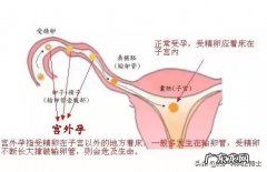 怀孕5周没有出血是不是就不是宫外孕