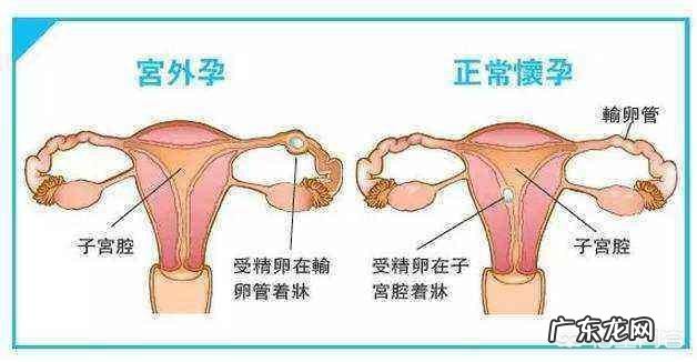 怀孕5周没有出血是不是就不是宫外孕