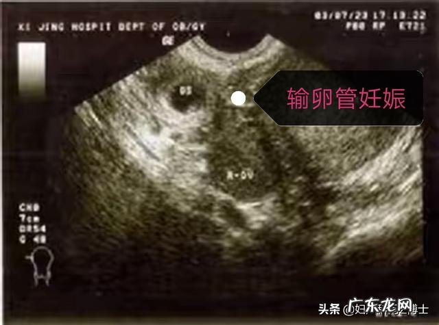 怀孕5周没有出血是不是就不是宫外孕