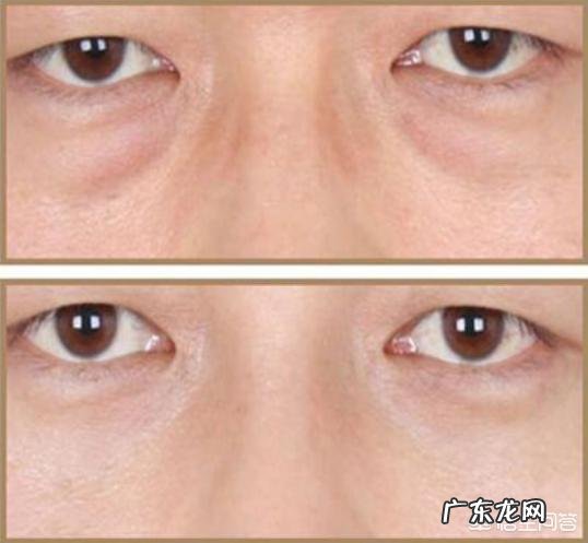 你有哪些消除眼袋的方法推荐