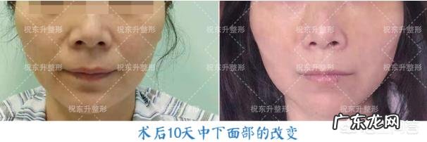 你有哪些消除眼袋的方法推荐