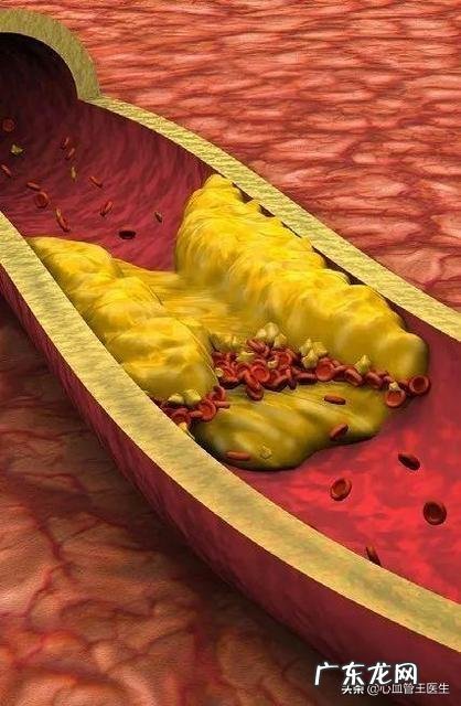 您好请问男40岁有高血压,适合吃鱼油预防心梗等疾病吗