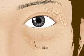 祛除下眼袋有什么好的方法吗