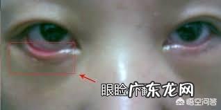 祛除下眼袋有什么好的方法吗