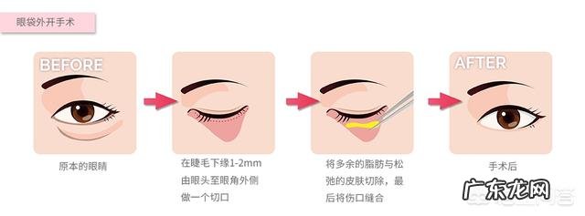 祛除下眼袋有什么好的方法吗