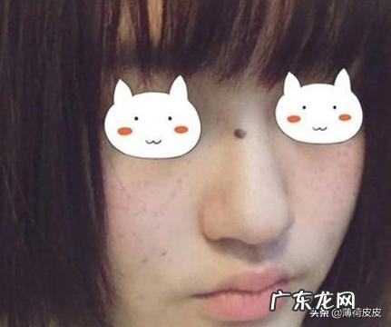 可不可以请大家推荐一下祛斑的方法