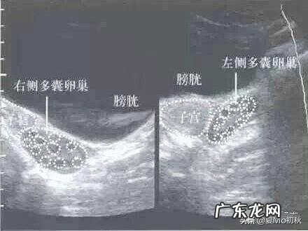 多囊卵巢如何从生活调理达到怀孕的目的