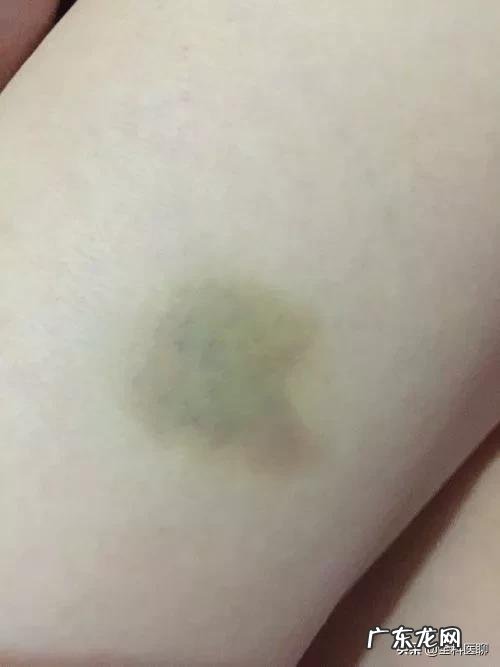 有些人的身体总是无缘无故出现淤青是怎么回事