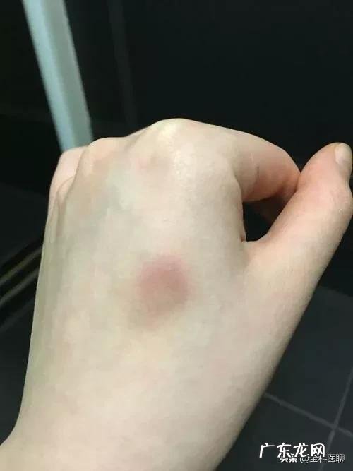 有些人的身体总是无缘无故出现淤青是怎么回事