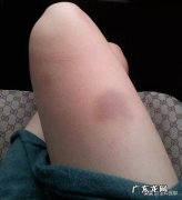 有些人的身体总是无缘无故出现淤青是怎么回事