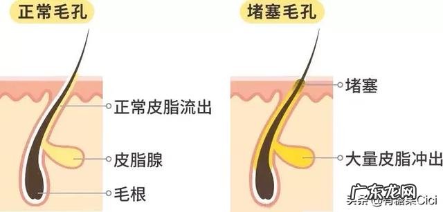 脸上总是长痘痘反复好不了,怎么办