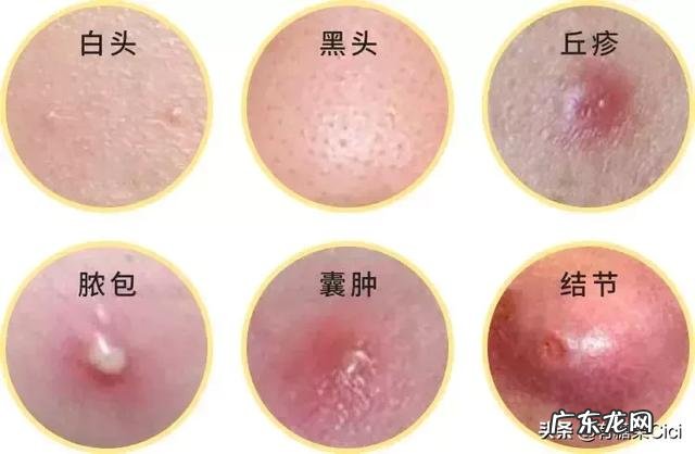 脸上总是长痘痘反复好不了,怎么办