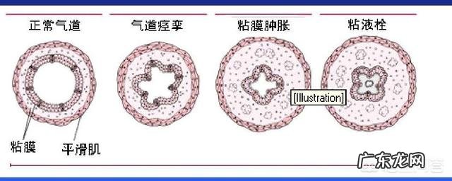 哪些常见药物容易引发哮喘应该如何预防药物性哮喘
