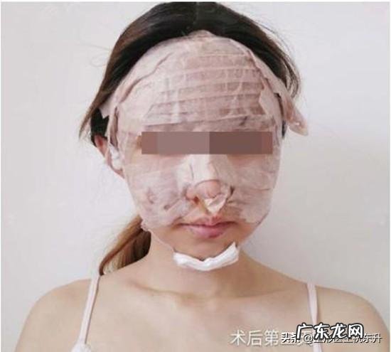 做完面部填充之后可以做水光针吗