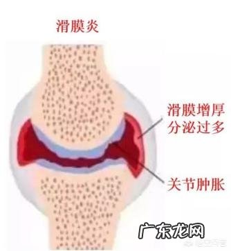 有滑膜炎的人能用懒人减肥法健身吗