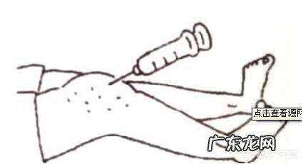 有滑膜炎的人能用懒人减肥法健身吗