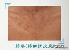 抑郁症吃的药会引起皮肤病吗