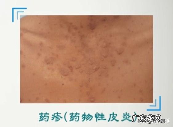 抑郁症吃的药会引起皮肤病吗