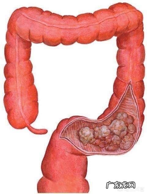 肠道息肉电切手术了,多久能恢复?